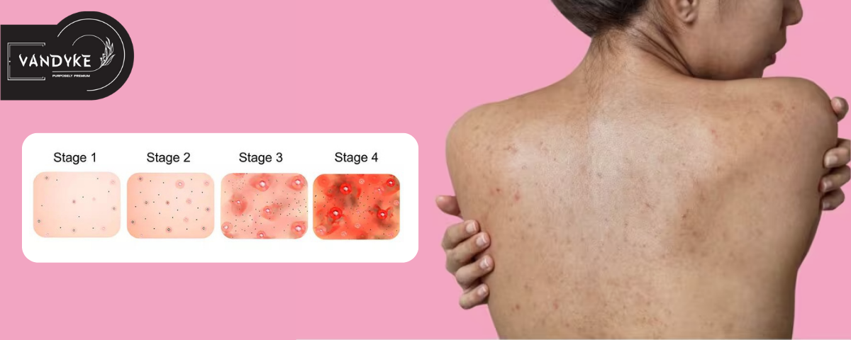 What Are The Causes of Body Acne - Vandyke