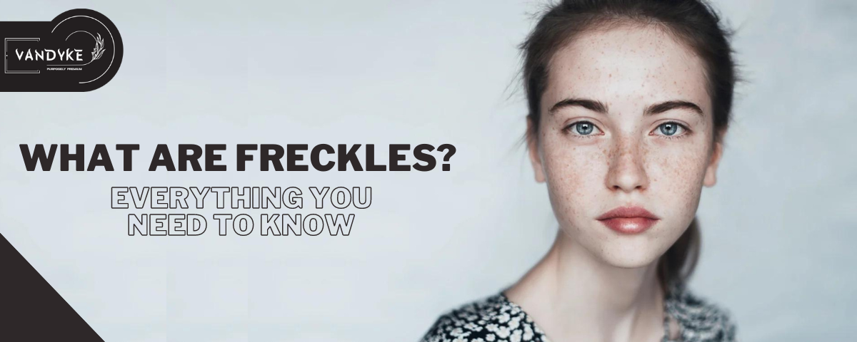 What Are Freckles - Vandyke